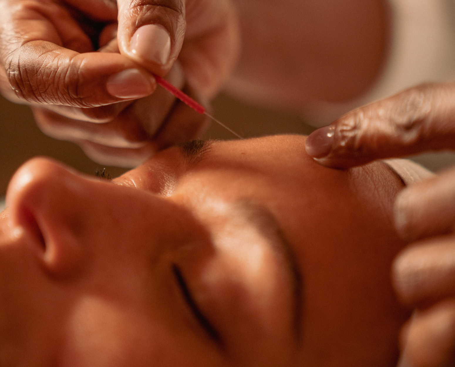 Acupuncture Facial Rejuvenation